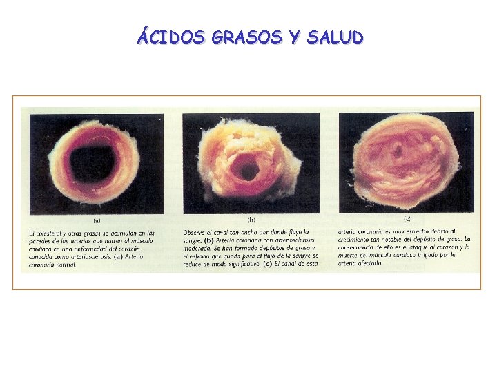 ÁCIDOS GRASOS Y SALUD ¿Crees que influyen de igual manera los ácidos grasos saturados ÁCIDOS GRASOS Y SALUD ¿Crees que influyen de igual manera los ácidos grasos saturados