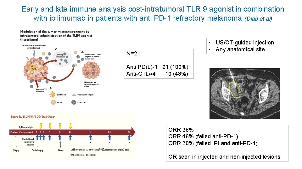Early and late immune analysis post-intratumoral TLR 9 agonist in combination with ipilimumab in