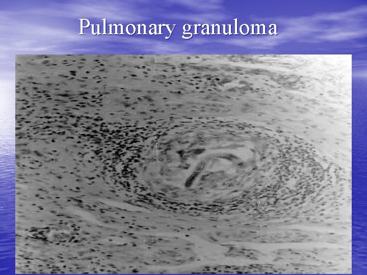 Pulmonary granuloma 