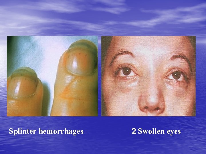  Splinter hemorrhages 2 Swollen eyes 