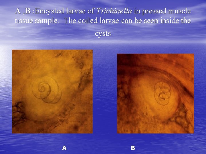 A , B : Encysted larvae of Trichinella in pressed muscle tissue sample. The