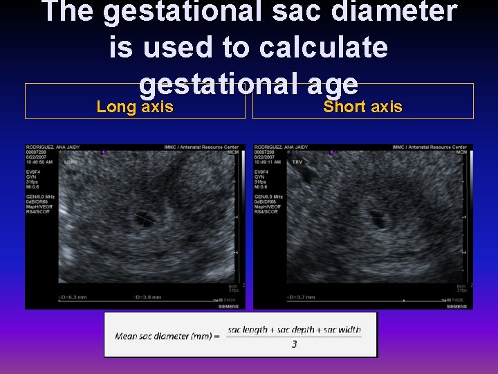 The gestational sac diameter is used to calculate gestational age Long axis Short axis