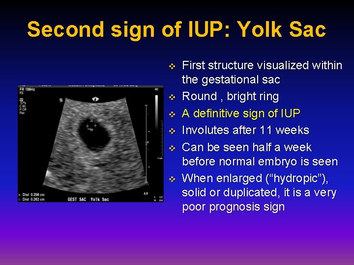 Second sign of IUP: Yolk Sac v v v First structure visualized within the