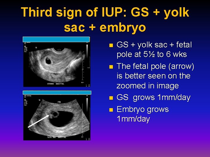 Third sign of IUP: GS + yolk sac + embryo n n GS +