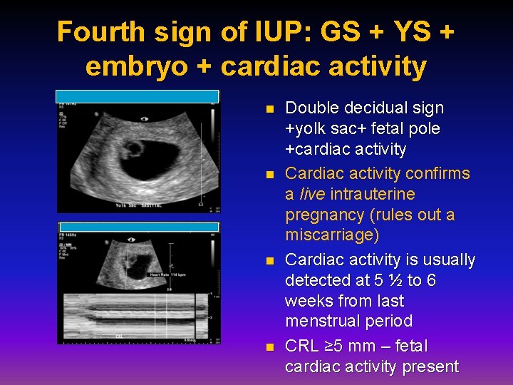 Fourth sign of IUP: GS + YS + embryo + cardiac activity n n