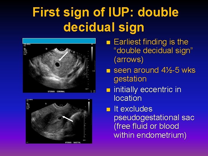 First sign of IUP: double decidual sign n n Earliest finding is the “double