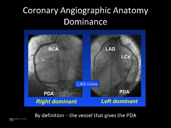 Coronary Angiographic Anatomy Dominance By definition – the vessel that gives the PDA 