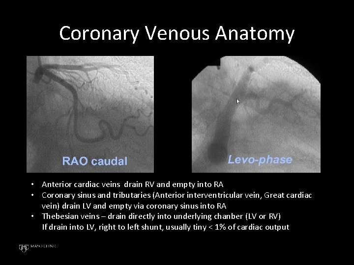 Coronary Venous Anatomy • Anterior cardiac veins drain RV and empty into RA •