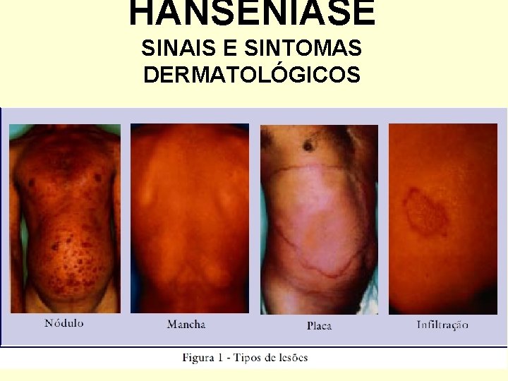 HANSENÍASE SINAIS E SINTOMAS DERMATOLÓGICOS 