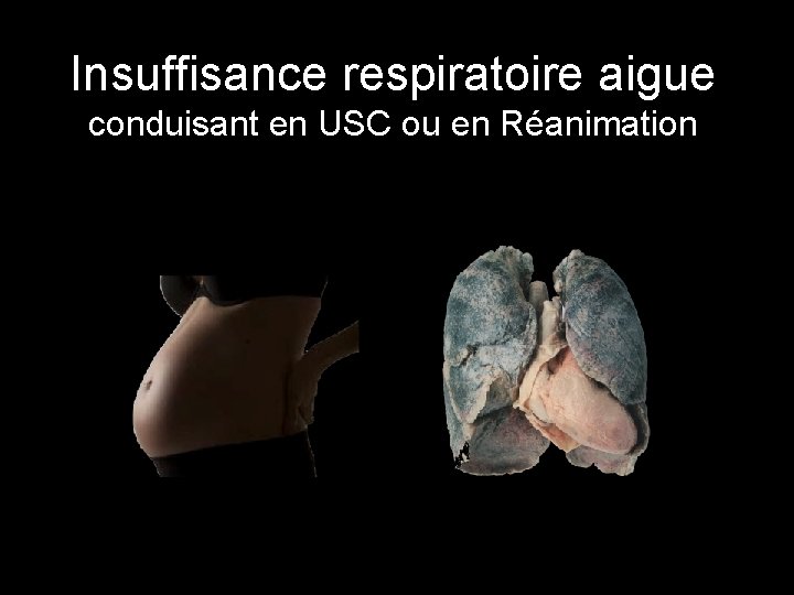 Insuffisance respiratoire aigue conduisant en USC ou en Réanimation 