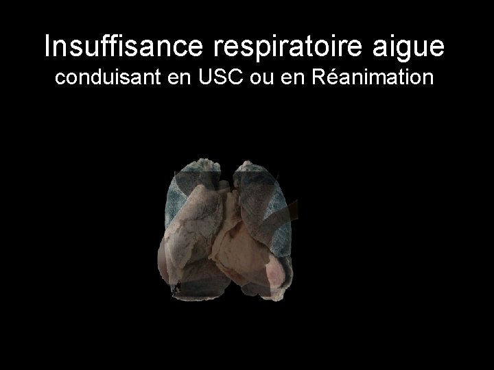 Insuffisance respiratoire aigue conduisant en USC ou en Réanimation 