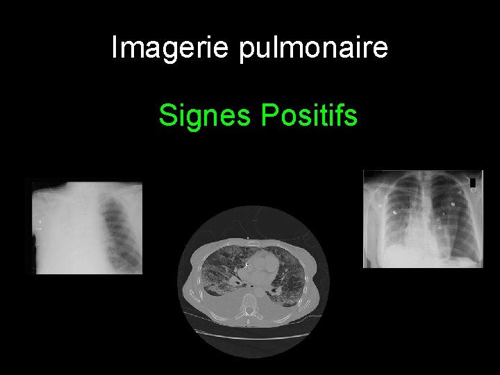 Imagerie pulmonaire Signes Positifs 