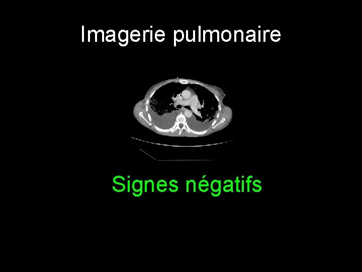 Imagerie pulmonaire Signes négatifs 