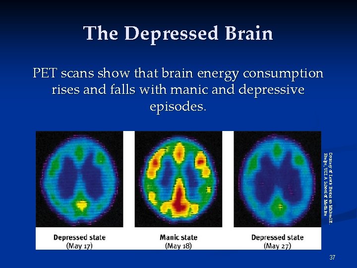 The Depressed Brain PET scans show that brain energy consumption rises and falls with The Depressed Brain PET scans show that brain energy consumption rises and falls with