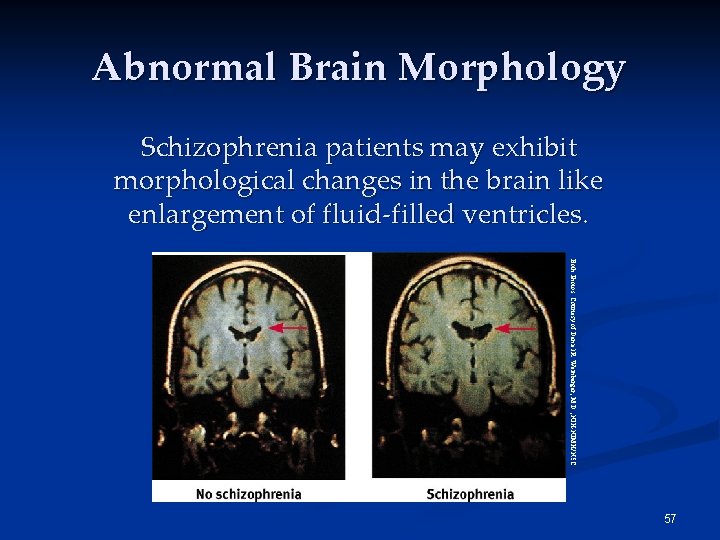 Abnormal Brain Morphology Schizophrenia patients may exhibit morphological changes in the brain like enlargement Abnormal Brain Morphology Schizophrenia patients may exhibit morphological changes in the brain like enlargement