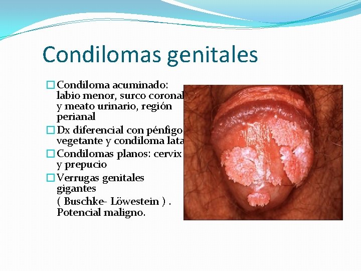 Condilomas genitales �Condiloma acuminado: labio menor, surco coronal y meato urinario, región perianal �Dx