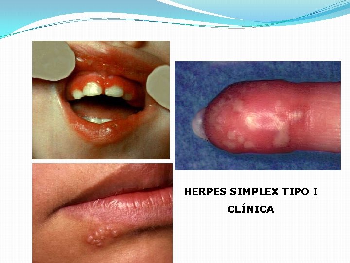 HERPES SIMPLEX TIPO I CLÍNICA 