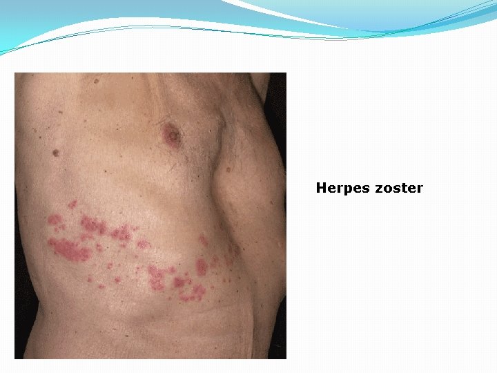 Herpes zoster 