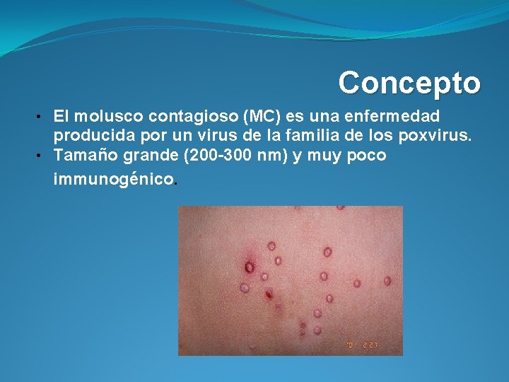 Concepto • El molusco contagioso (MC) es una enfermedad producida por un virus de