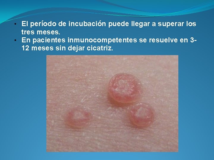  • El período de incubación puede llegar a superar los tres meses. •