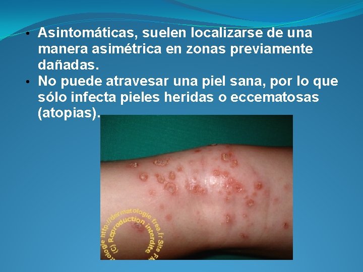  • Asintomáticas, suelen localizarse de una manera asimétrica en zonas previamente dañadas. •