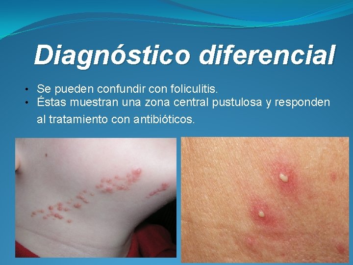 Diagnóstico diferencial • Se pueden confundir con foliculitis. • Éstas muestran una zona central