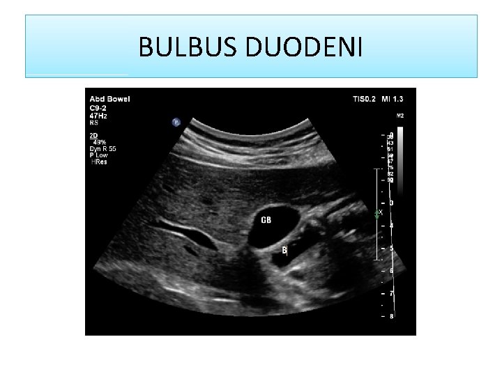 BULBUS DUODENI 