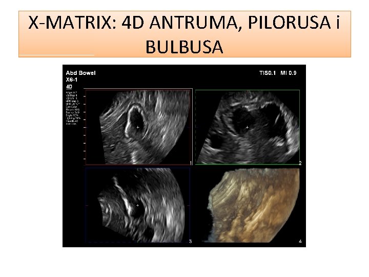 X-MATRIX: 4 D ANTRUMA, PILORUSA i BULBUSA 