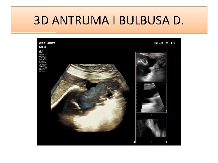 3 D ANTRUMA I BULBUSA D. 3 D ANTRUMA I BULBUSA D.