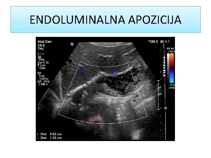 ENDOLUMINALNA APOZICIJA ENDOLUMINALNA APOZICIJA