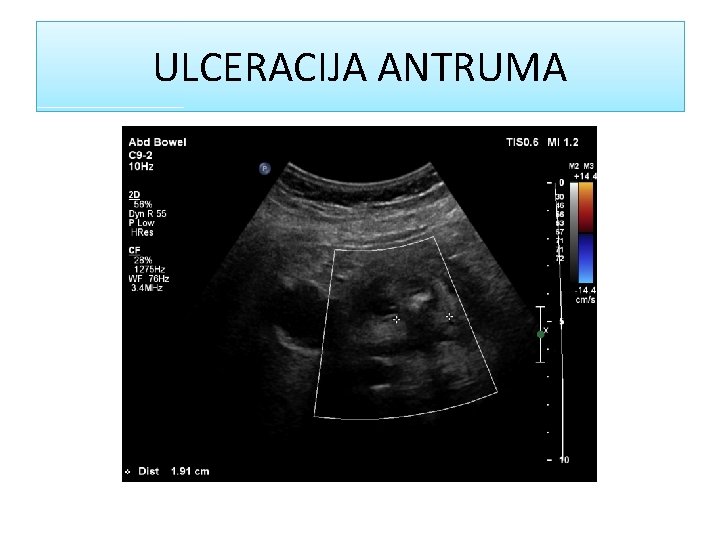 ULCERACIJA ANTRUMA 