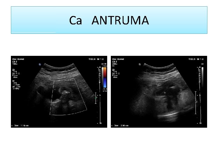 Ca ANTRUMA 