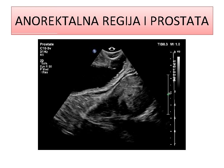 ANOREKTALNA REGIJA I PROSTATA 