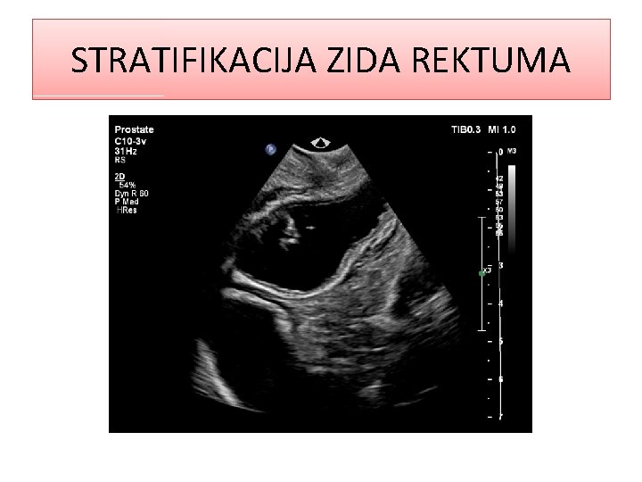 STRATIFIKACIJA ZIDA REKTUMA 