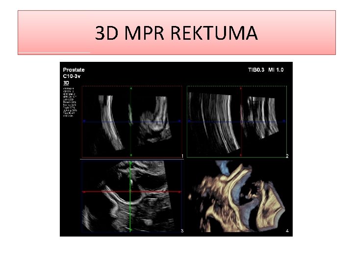 3 D MPR REKTUMA 