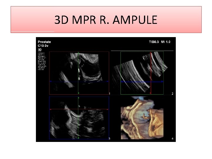 3 D MPR R. AMPULE 