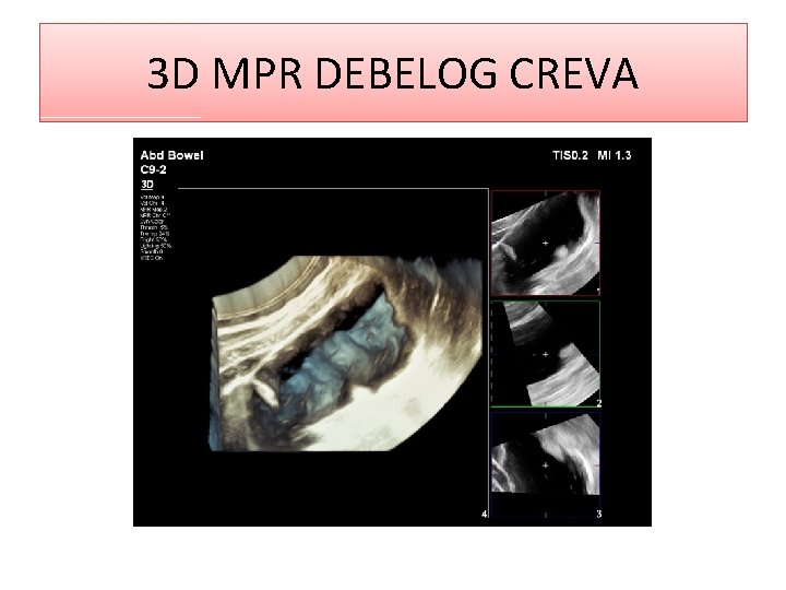 3 D MPR DEBELOG CREVA 