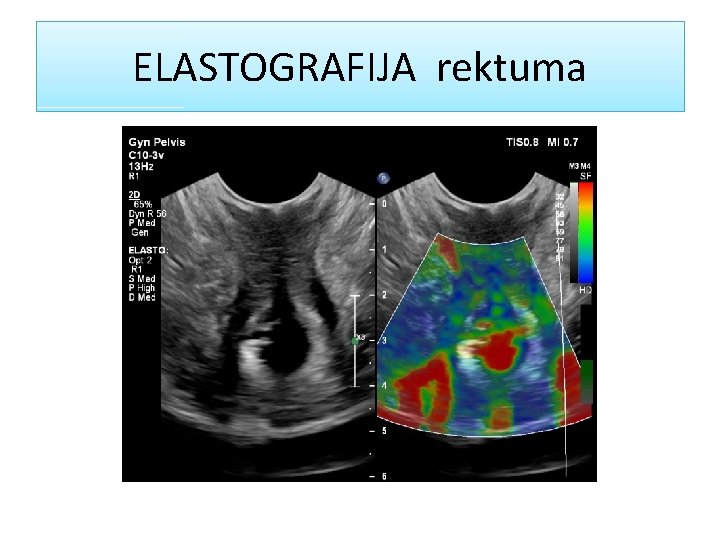 ELASTOGRAFIJA rektuma 