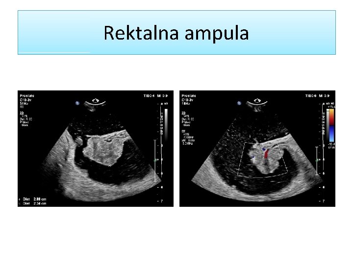 Rektalna ampula 