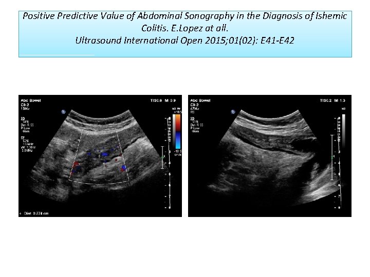 Positive Predictive Value of Abdominal Sonography in the Diagnosis of Ishemic Colitis. E. Lopez Positive Predictive Value of Abdominal Sonography in the Diagnosis of Ishemic Colitis. E. Lopez