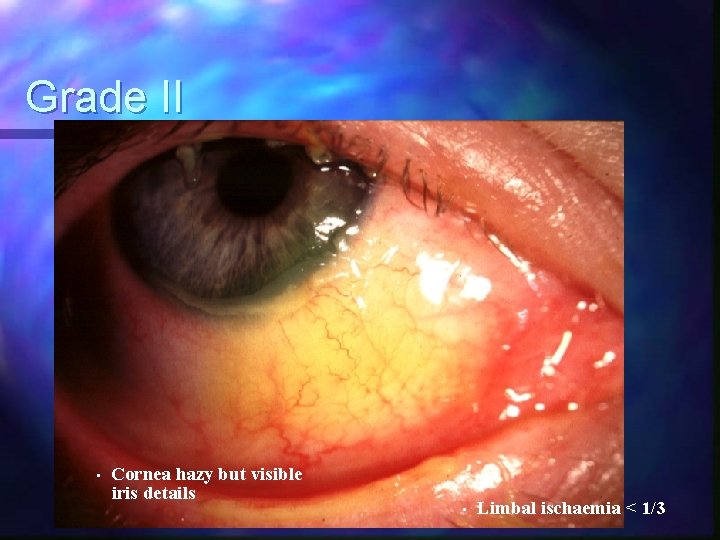 Grade II • Cornea hazy but visible iris details • Limbal ischaemia < 1/3