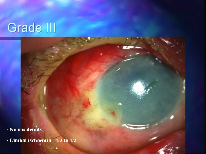 Grade III • No iris details • Limbal ischaemia - 1/3 to 1/2 