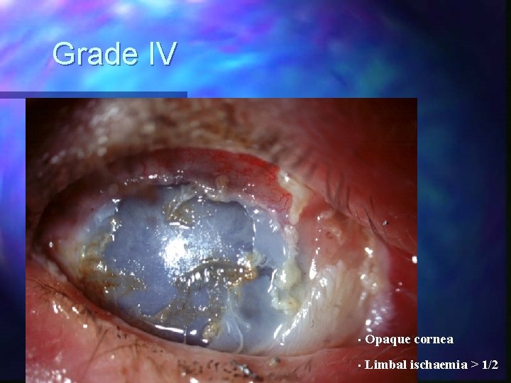 Grade IV • Opaque cornea • Limbal ischaemia > 1/2 