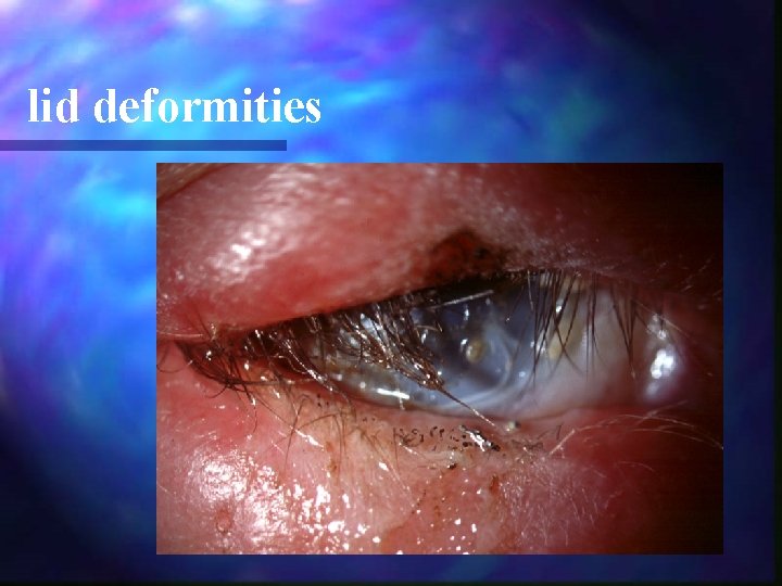 lid deformities 