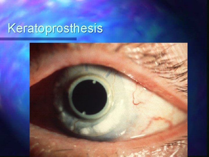 Keratoprosthesis 