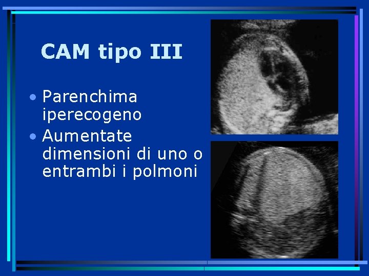 CAM tipo III • Parenchima iperecogeno • Aumentate dimensioni di uno o entrambi i
