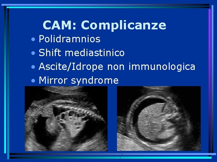 CAM: Complicanze • Polidramnios • Shift mediastinico • Ascite/Idrope non immunologica • Mirror syndrome