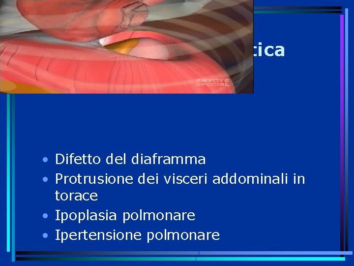 Ernia diaframmmatica (CDH) • Difetto del diaframma • Protrusione dei visceri addominali in torace