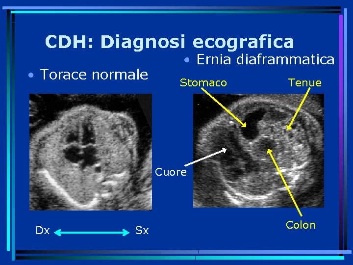 CDH: Diagnosi ecografica • Torace normale • Ernia diaframmatica Stomaco Tenue Cuore Dx Sx