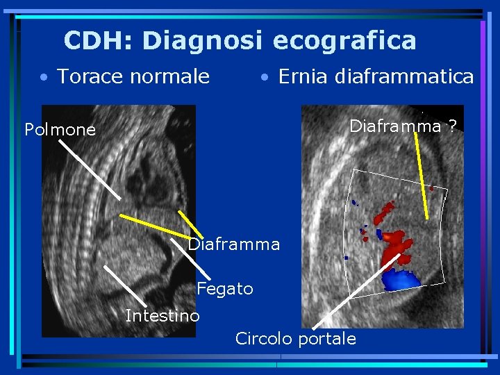 CDH: Diagnosi ecografica • Torace normale • Ernia diaframmatica Diaframma ? Polmone Diaframma Fegato